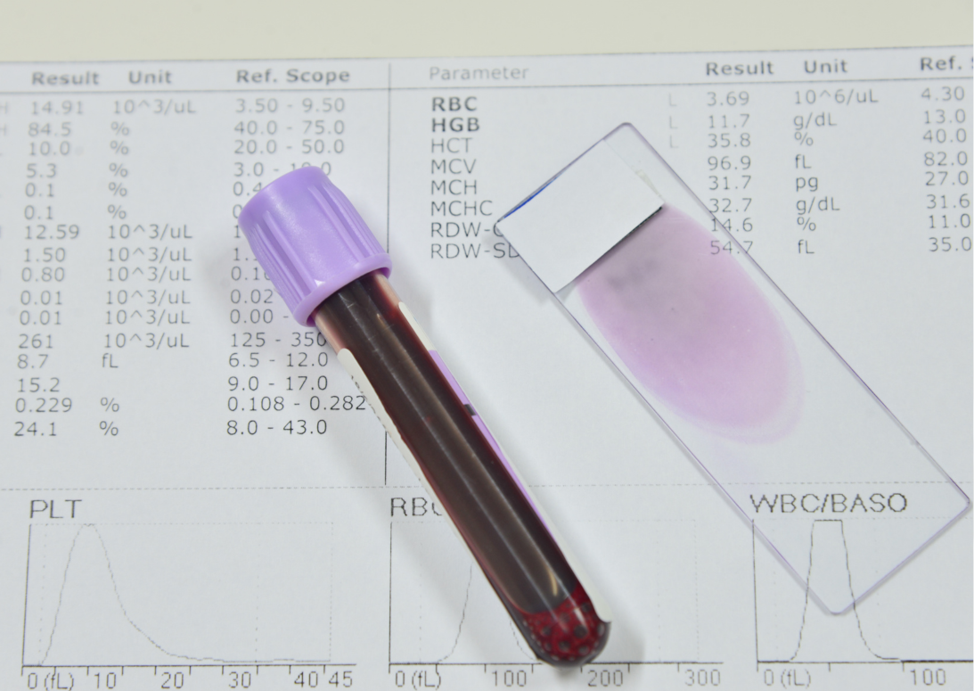 Mitől lehet alacsonyabb a hemoglobin szintje?