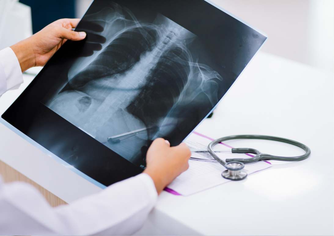 Mit árul el a mellkasi röntgenfelvétel?